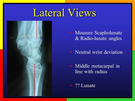 Wrist Xray Lateral