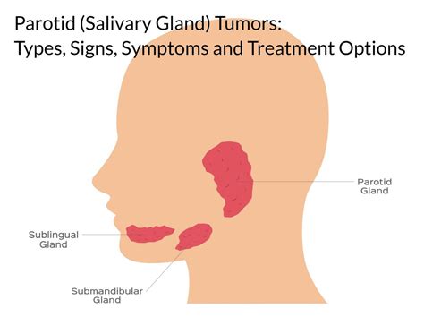 Parotid (Salivary Gland) Tumors: Types, Symptoms, and Treatments