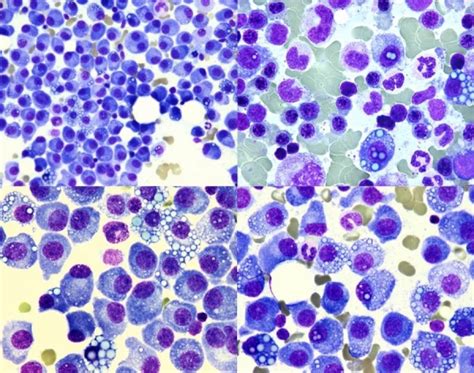 Multiple myeloma. Mott cells, Dutcher bodies and Russell bodies