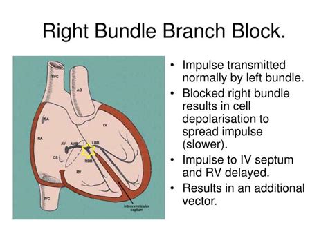 Right Versus Left Bundle Branch Block