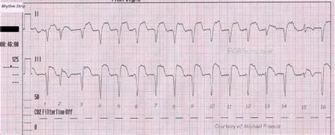 Accelerated idioventricular rhythm | ECG Guru - Instructor Resources