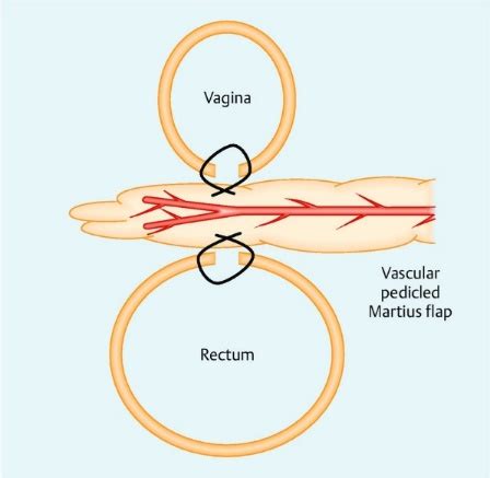 Modified Martius Flap for repair of a postradiation Rectovaginal ...