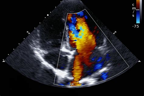 Having an Echocardiogram: What You Need to Know | UPMC HealthBeat