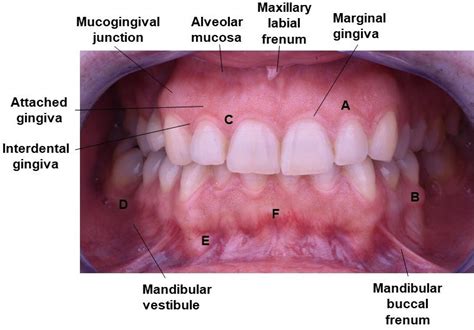 Clinical appearance of gingiva: A) Attached gingiva above and ...