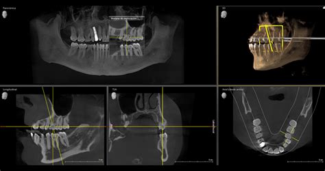 Cone beam 3D bimaxilar - Odonto Imax