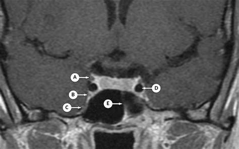 Superior Orbital Fissure Radiology