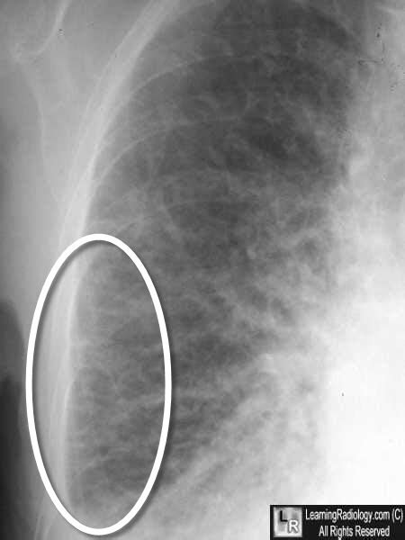 Learning Radiology - Congestive Heart Failure, Pulmonary Edema