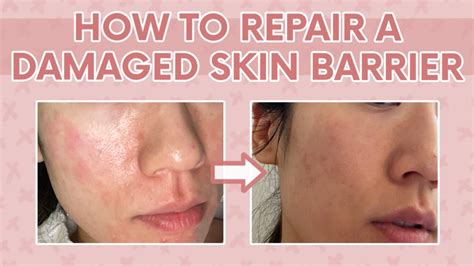 How to Heal a Damaged Skin Barrier 101 | Tips to Repair a Damaged ...