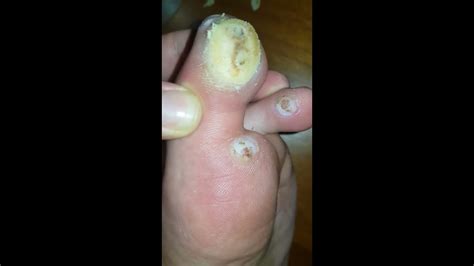 Planters Wart On Hand Removal | Bruin Blog