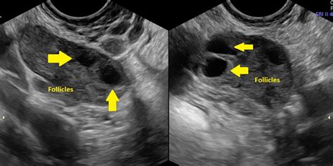 Normal Vs Polycystic Ovaries Ultrasound