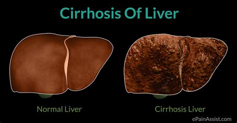 Cirrhosis Symptoms | tenderness.co