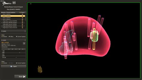 MRI Prostate Biopsy - Tower Urology