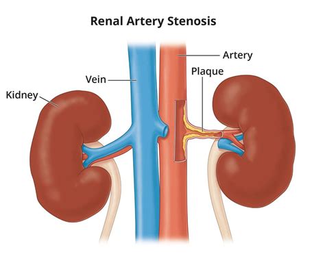 Renal Artery