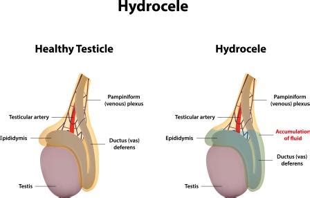 Hydrocele: Prevention, Home Remedies, Useful Yogasanas