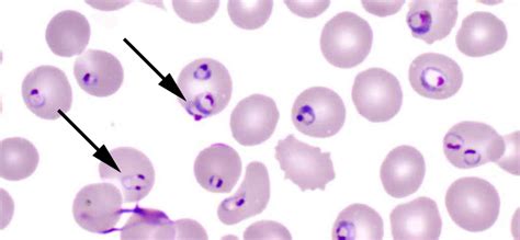 Plasmodium Falciparum Under Microscope