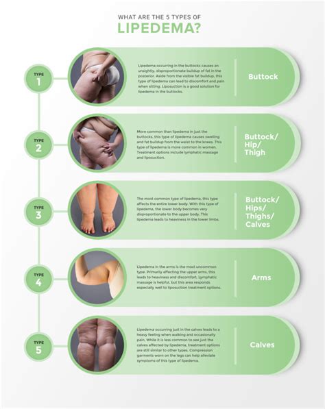 Learn About Stages and Types of Lipedema | Lipedema.net