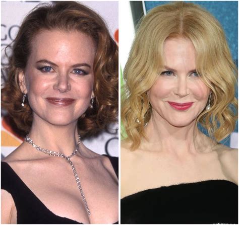 Nicole Kidman’s Before and After Photos Look Different, but She Denied ...