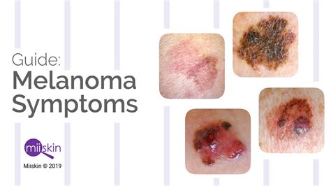 Symptoms Of Melanoma