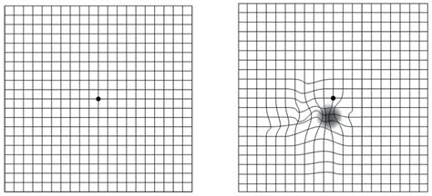 Macular Degeneration Grid Printable