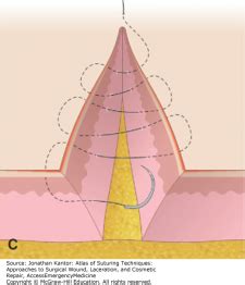 Suturing- intradermal/subcuticular pattern – Large Animal Surgery ...