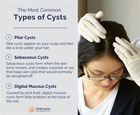 Sebaceous Cyst Epidermal Cyst Pictures Causes Treatment And Removal ...