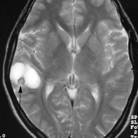 Pleomorphic xanthoastrocytoma | Eurorad