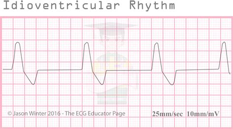 ECG Educator Blog : Ventricular Rhythms