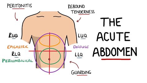 Acute Abdomen - A Guide to Acute Abdominal Pain - YouTube