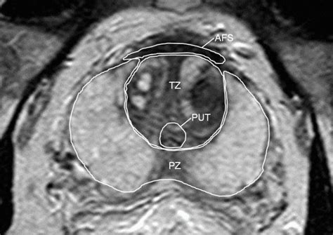 Zonal prostate anatomy on axial T2-weighted MRI image: peripheral zone ...