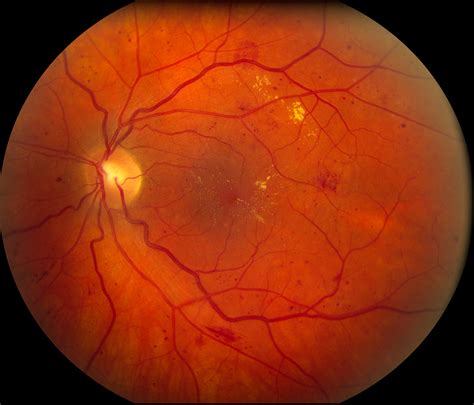 About diabetic retinopathy | Carver College of Medicine