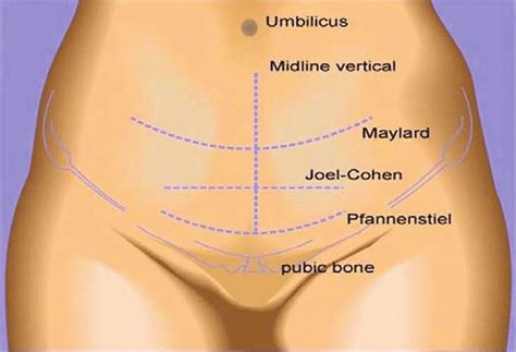 Cesarean Section - Procedure, Recovery, Complications