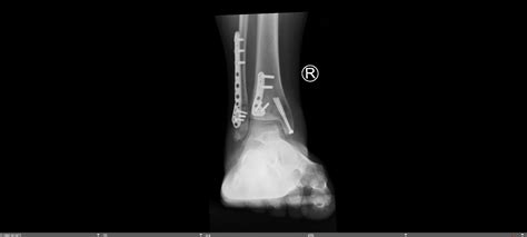 Trimalleolar Ankle Fracture — Chicago Foot & Ankle Orthopaedic Surgeons