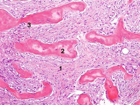 Periosteal Osteosarcoma | Radiology Key