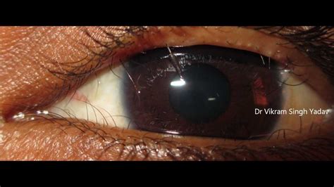 What Is Trichiasis ? - YouTube