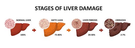 Stages Of Liver Damage Healthy Fatty Liver Fibrosis And Cirrhosis Stock ...