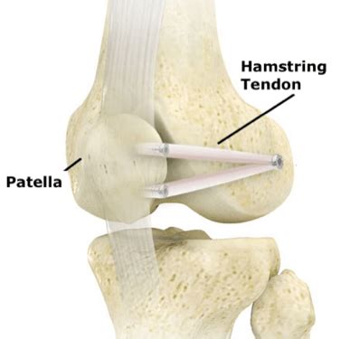 MPFL Reconstruction Surgery - Dr Shannon Sim