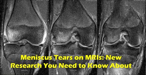 Meniscus Tear MRI? - Please Read This