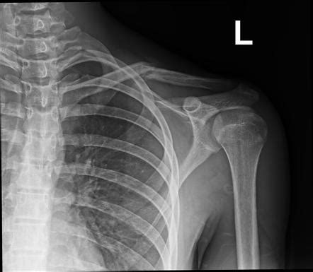 Clavicle fracture | Radiology Case | Radiopaedia.org