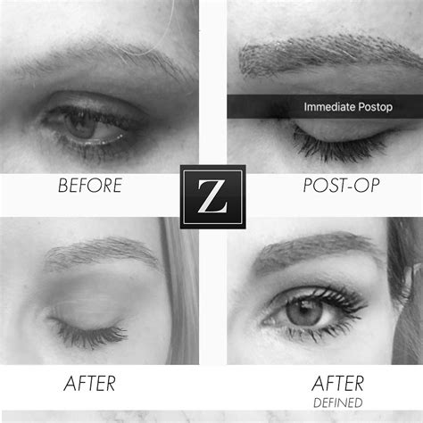 Eyebrow Transplant Procedure | CONTACT US | Ziering Medical