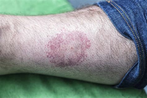 Erythema Migrans