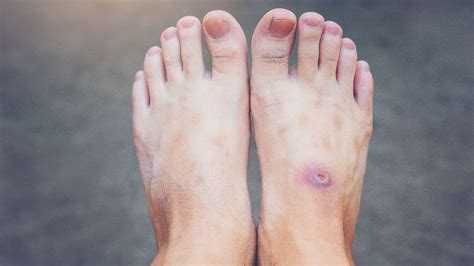 Understanding the link between diabetes and wound healing | HealthShots