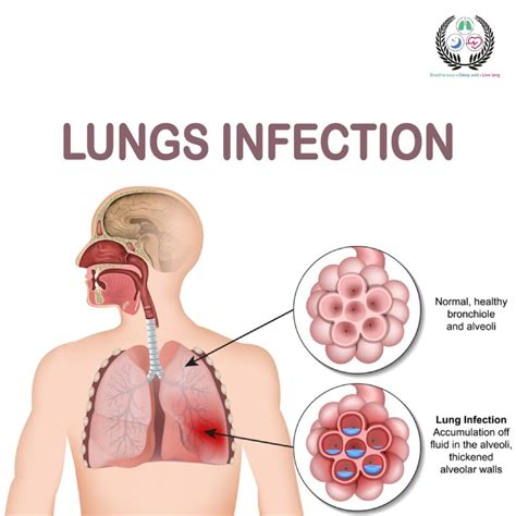 Lung Infection: Types, Symptoms, Treatment Guide