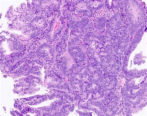 Pathology Outlines - Endometrial hyperplasia