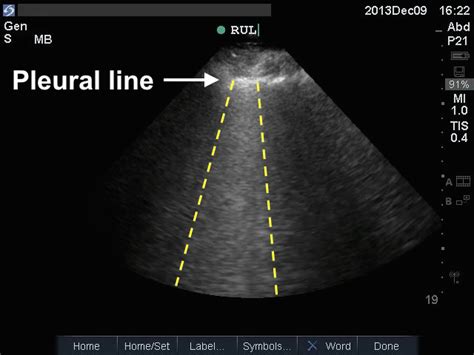 Teaching Medicine - Tutorial: Lung Ultrasound