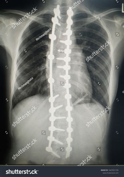 24 Tl Spine Images, Stock Photos, 3D objects, & Vectors | Shutterstock