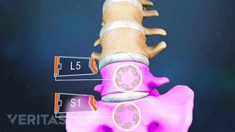 Lumbar L5-S1 Disc Herniation, 46% OFF | www.elevate.in