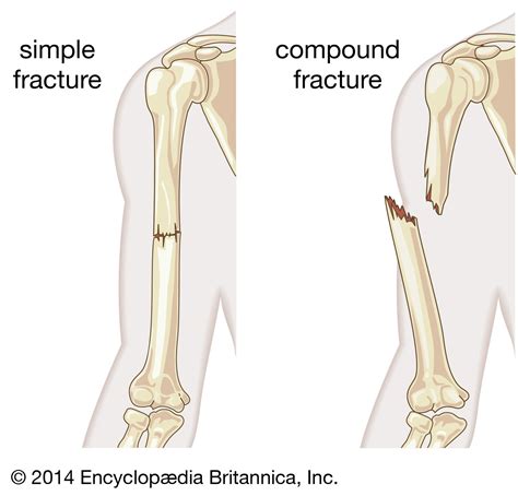 Complete Fracture Diagram