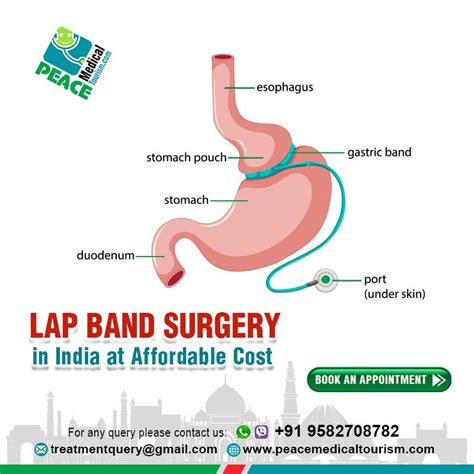 "Best Lap Band Surgery at Affordable Cost" | Lap band surgery, Lap band ...