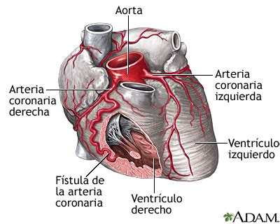 Fístula de la arteria coronaria: MedlinePlus enciclopedia médica