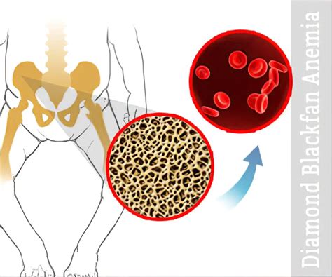 Diamond Blackfan Anemia: Causes, Diagnosis and Treatments